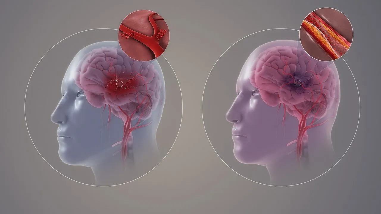 https://e-neurologos.gr/aggeiako-egkefaliko-epeisodio/